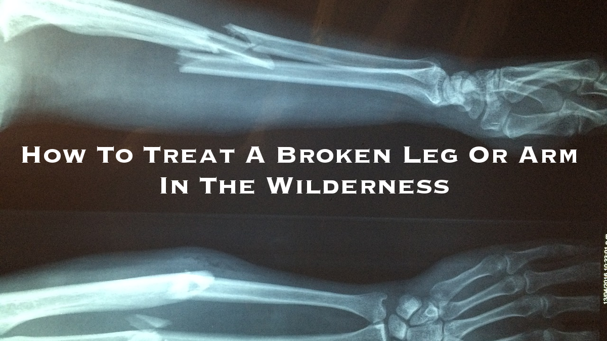 How To Treat A Broken Leg In The Wilderness
